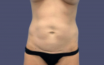 Abdominoplasty (Tummy Tuck) 9 Before